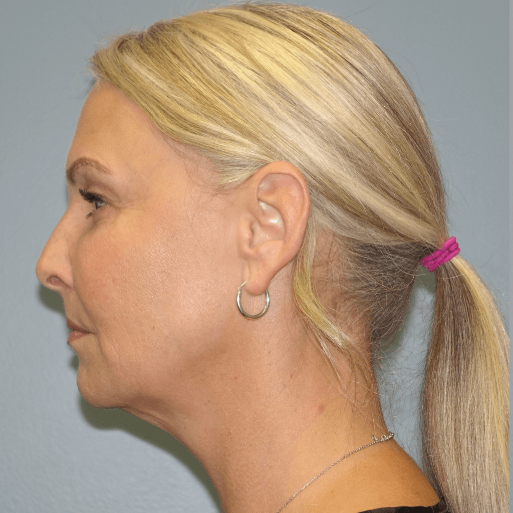 Before Dr. Finger performed Renuvion Liposuction