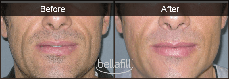 bellafill-before-and-after- BELLAFILL ON A MAN BEFORE AND AFTER
