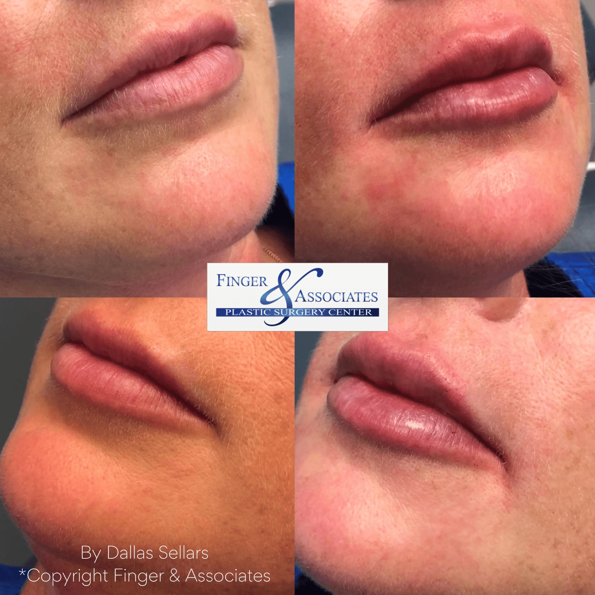 Before and immediately after 1/2 syringe of Juvederm