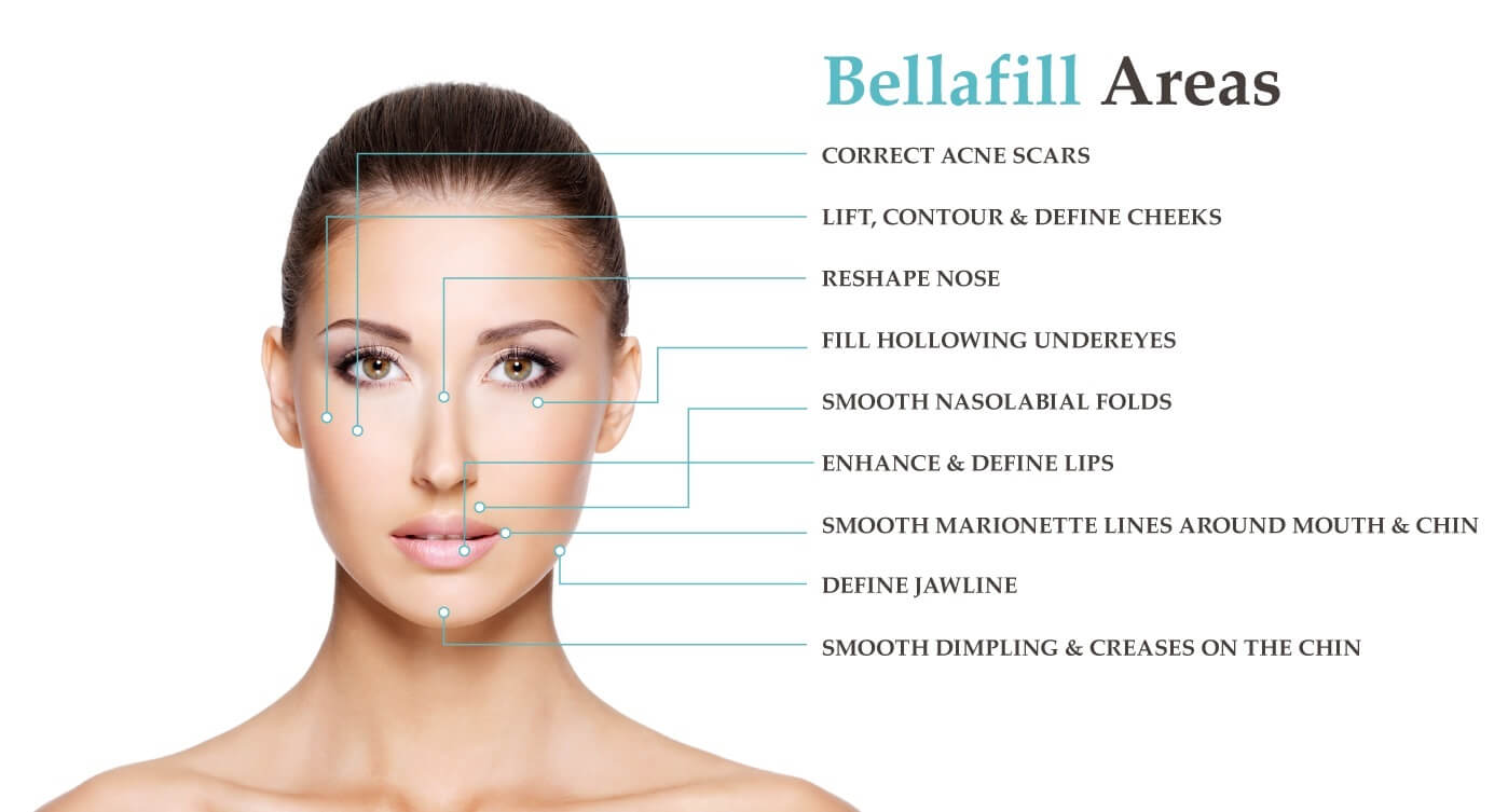 Bellafill by Dr. E. Ronald Finger Bellafill areas you can have it injected - image