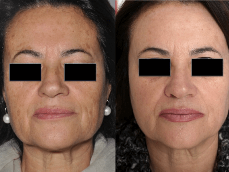 Before and After CoolPeel Skin Resurfacing Treatment offered at FInger and Associates