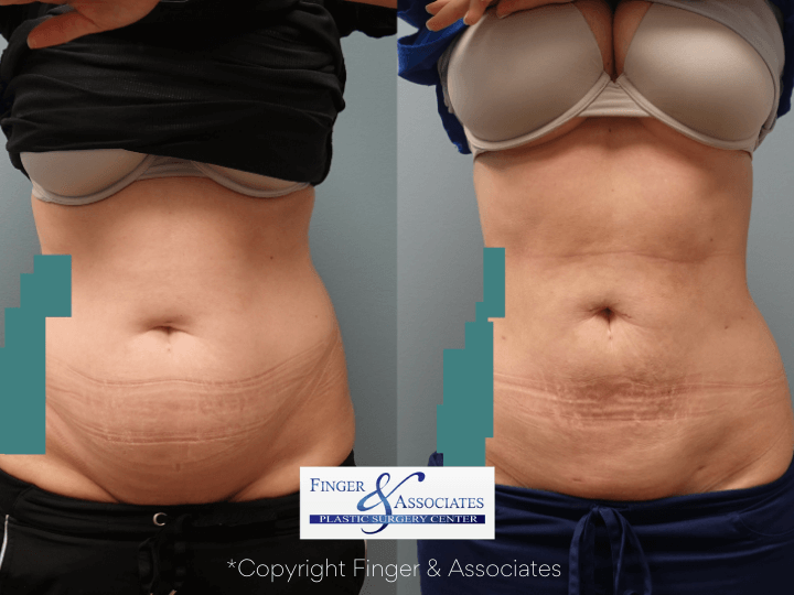 Before and after Liposuction of abs and hip rolls plus reunion