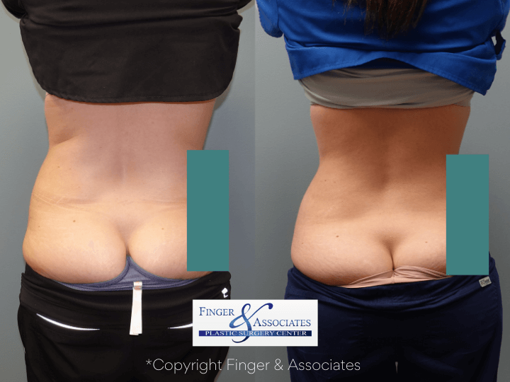Before and after 3-months of Liposuction on abdomen and hip rolls plus Renuvion for Skin Tightening