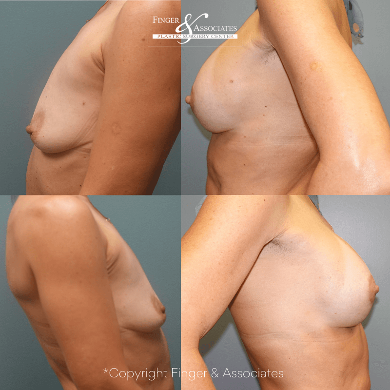 Before and after 11-months of Breast Lift and Breast Augmentation
