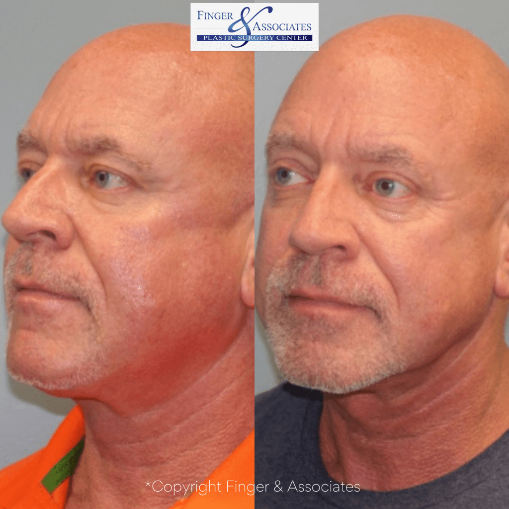 Before and after Liposuction and Renuvion of the neck