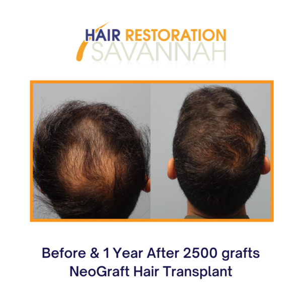 NeoGraft Now ONLY $ per Graft | Call Hair Restoration Savannah