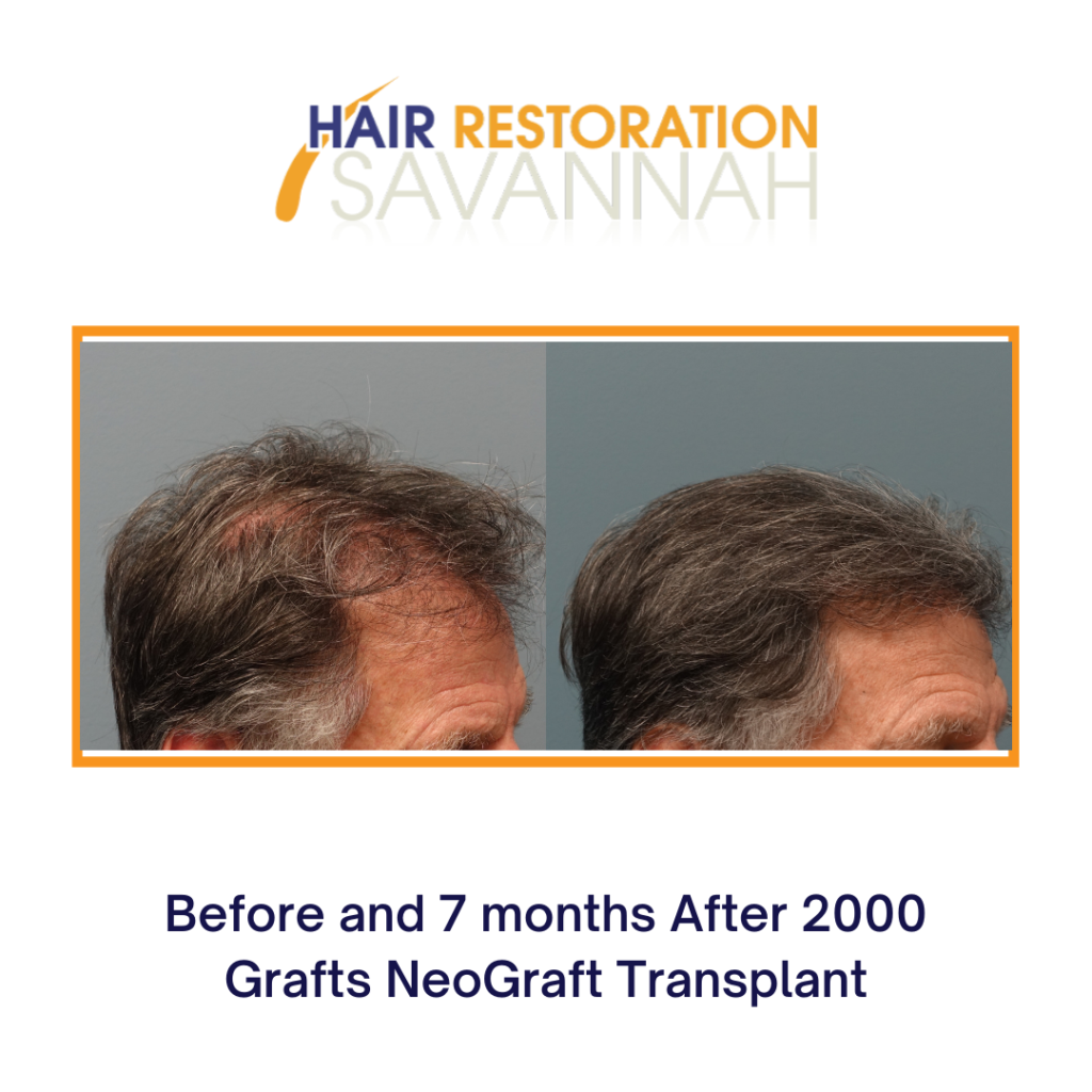 Before and after Neograft