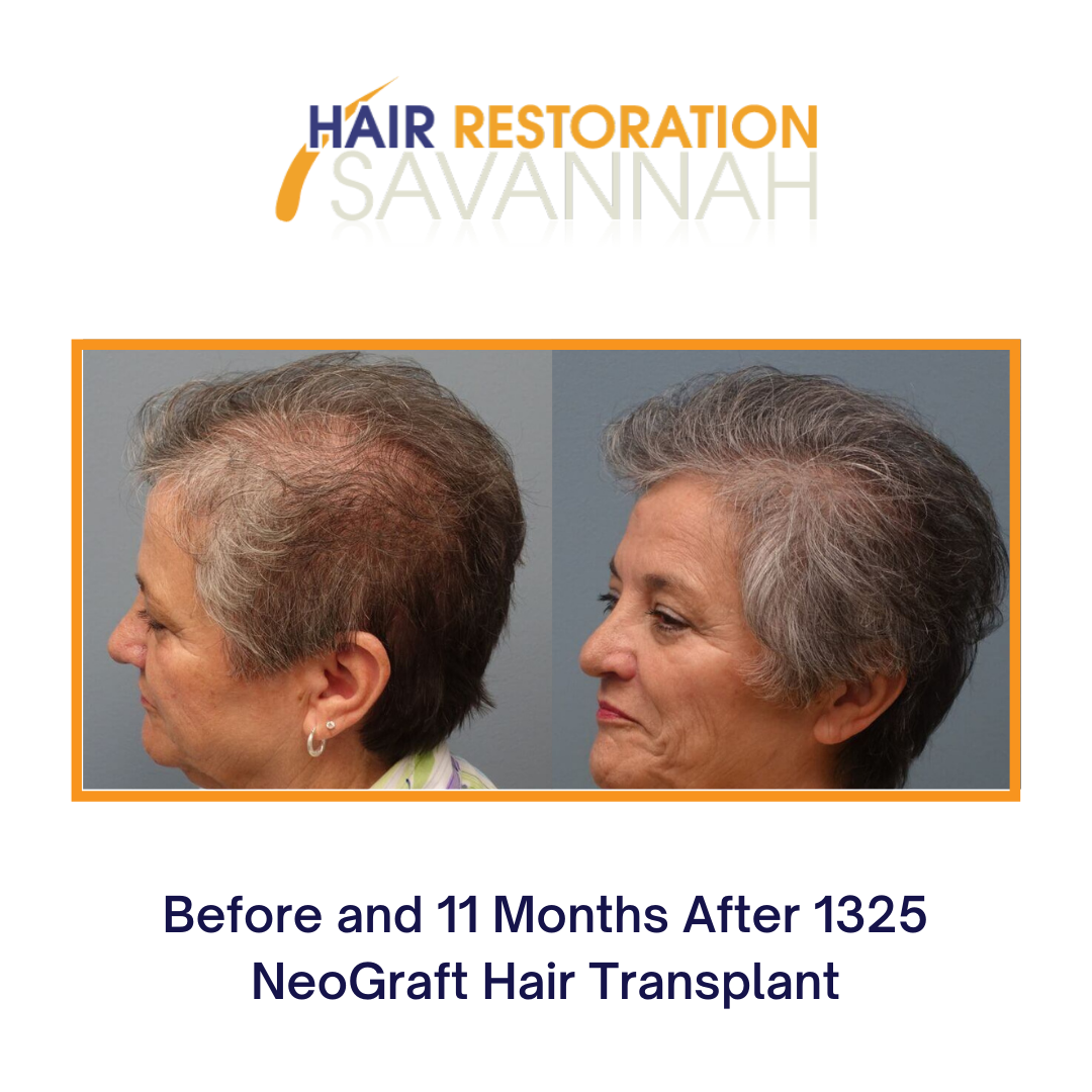 Before and after PRP and NeoGraft