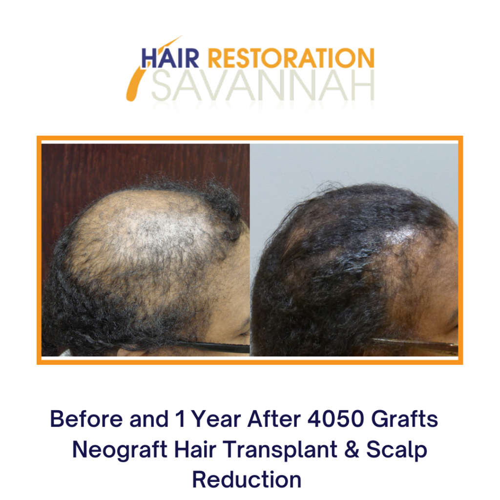 Before and after Neograft Hair Restoration