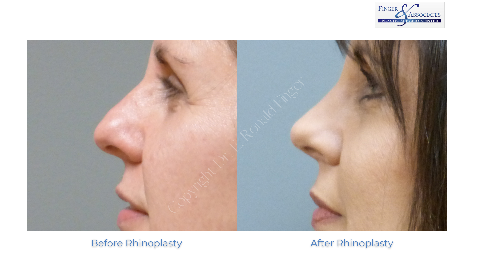 before and after Rhinoplasty