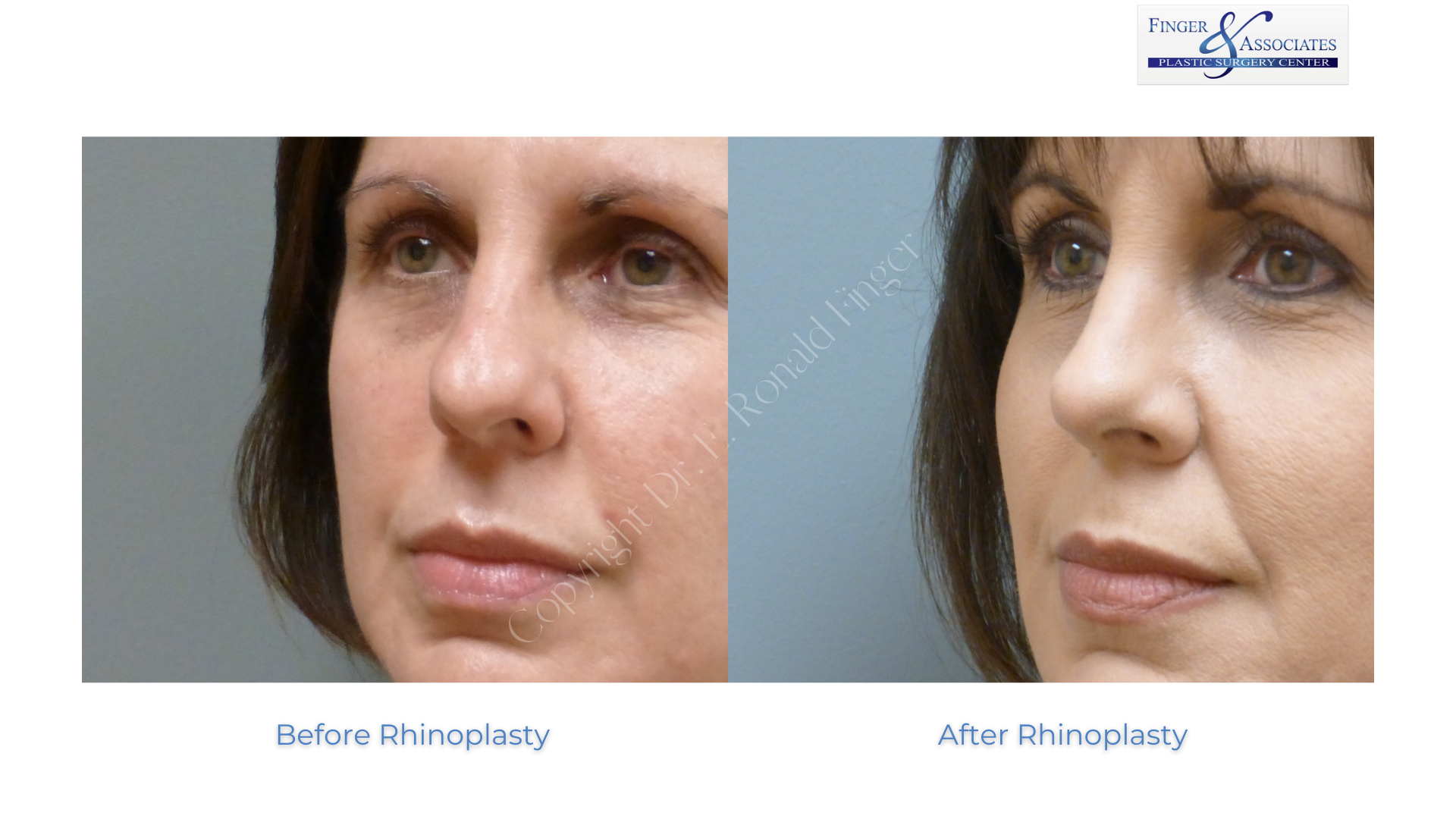 Before and after Rhinoplasty