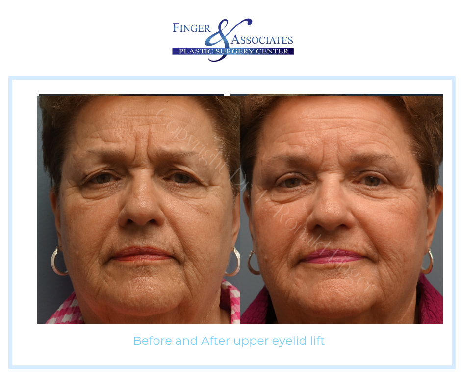 Before and after eyelid lift