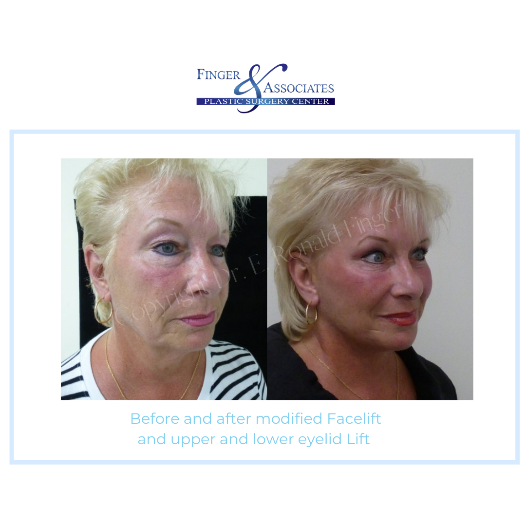 Before and after modified facelift and lower and upper eyelid lift
