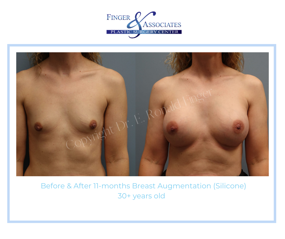 Before and after Breast Augmentation