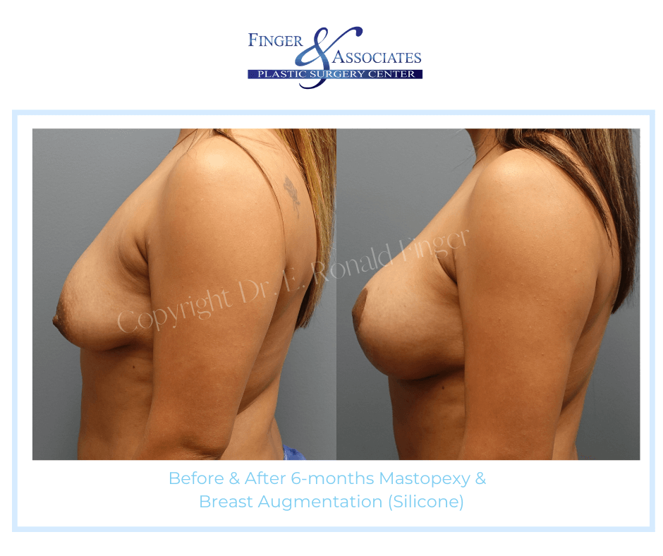 before and after breast lift and breast augmentation