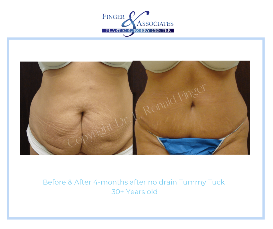 Before and after no drain tummy tuck