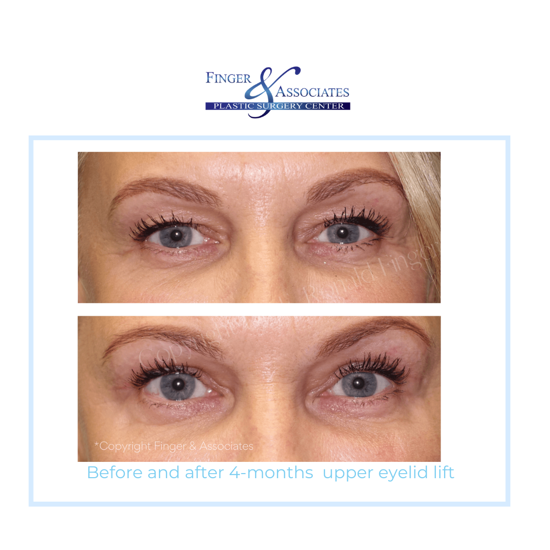 before and after upper eyelid lift