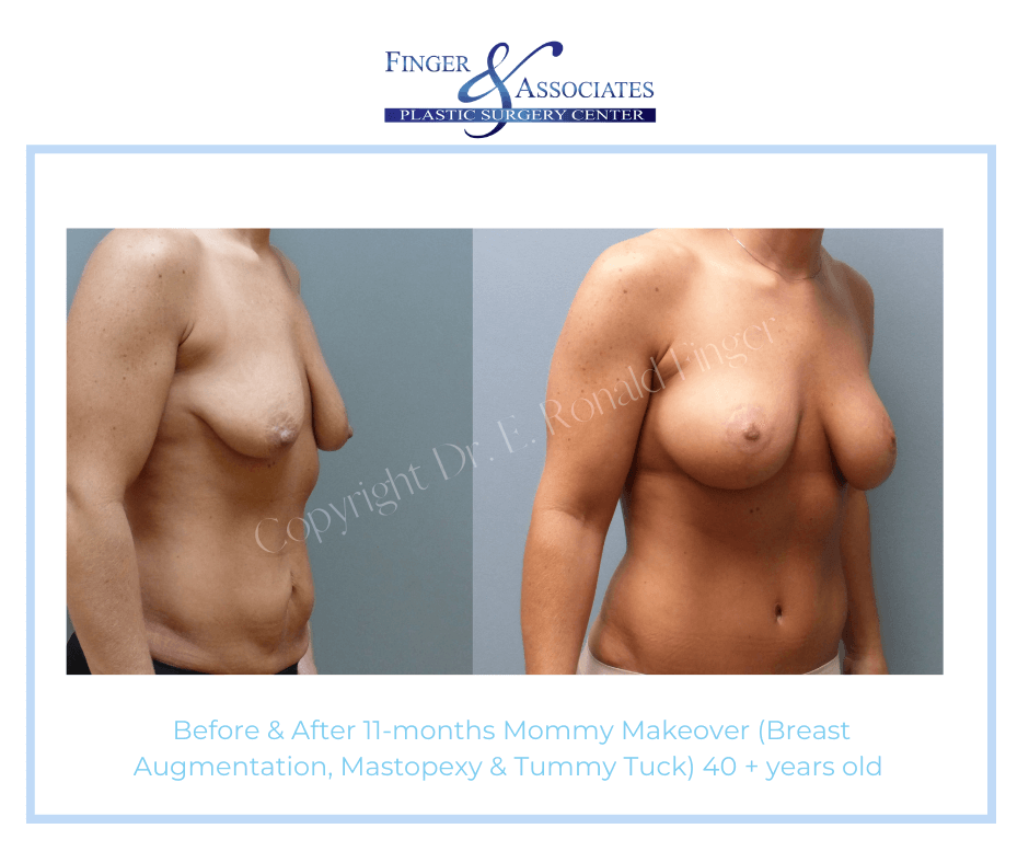Before and After 11-months Mommy Makeover (Breast Augmentation, Mastopexy and Tummy Tuck) 40+ years old