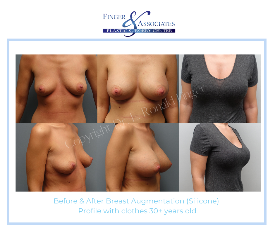 Before and after Breast Augmentation high profile