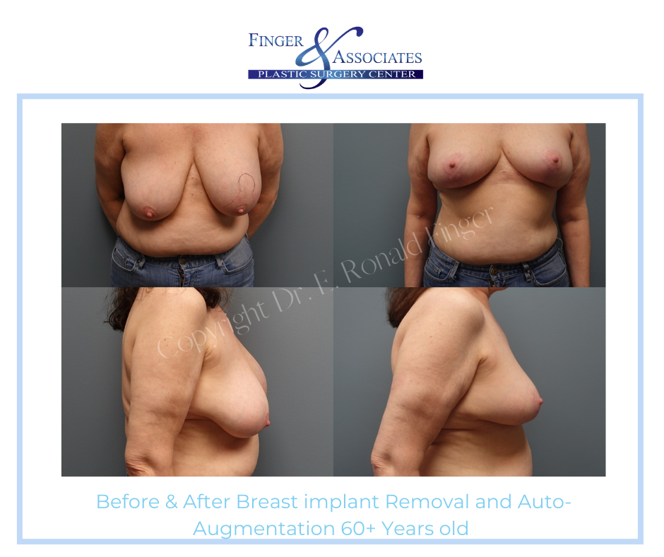 Before and After Breast implant removal and Auto-Augmentation 60+ years old