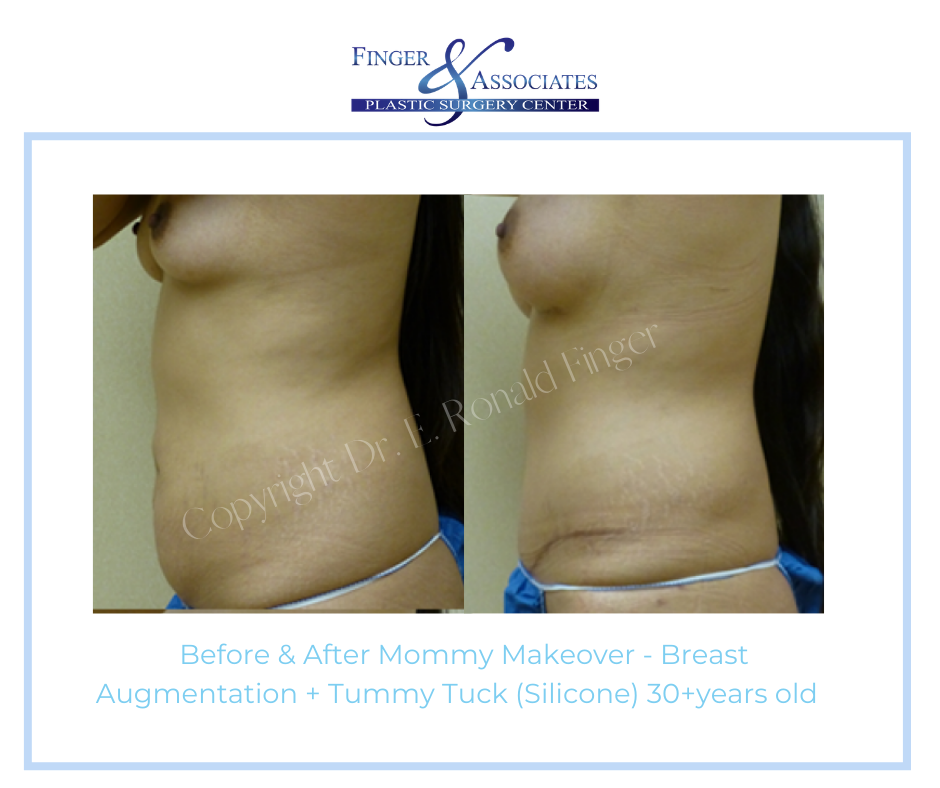 Before and after Tummy Tuck with Liposuction
