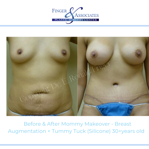 Before and After Mommy Makeover - Breast Augmentation + Tummy Tuck (Silicone) 30+ years old