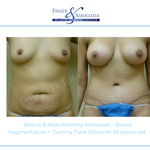 Breast Augmentation Bryn Mawr