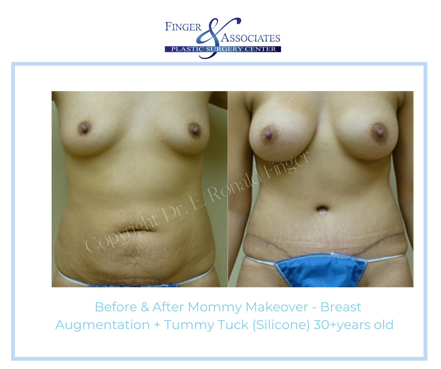 Before and After Mommy Makeover - Breast Augmentation + Tummy Tuck (Silicone) 30+ years old