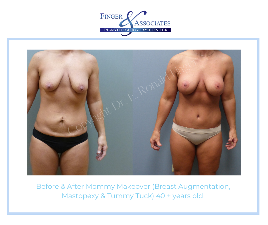 Before and After Mommy Makeover (Breast Augmentation, Mastopexy and Tummy Tuck) 40+ years old