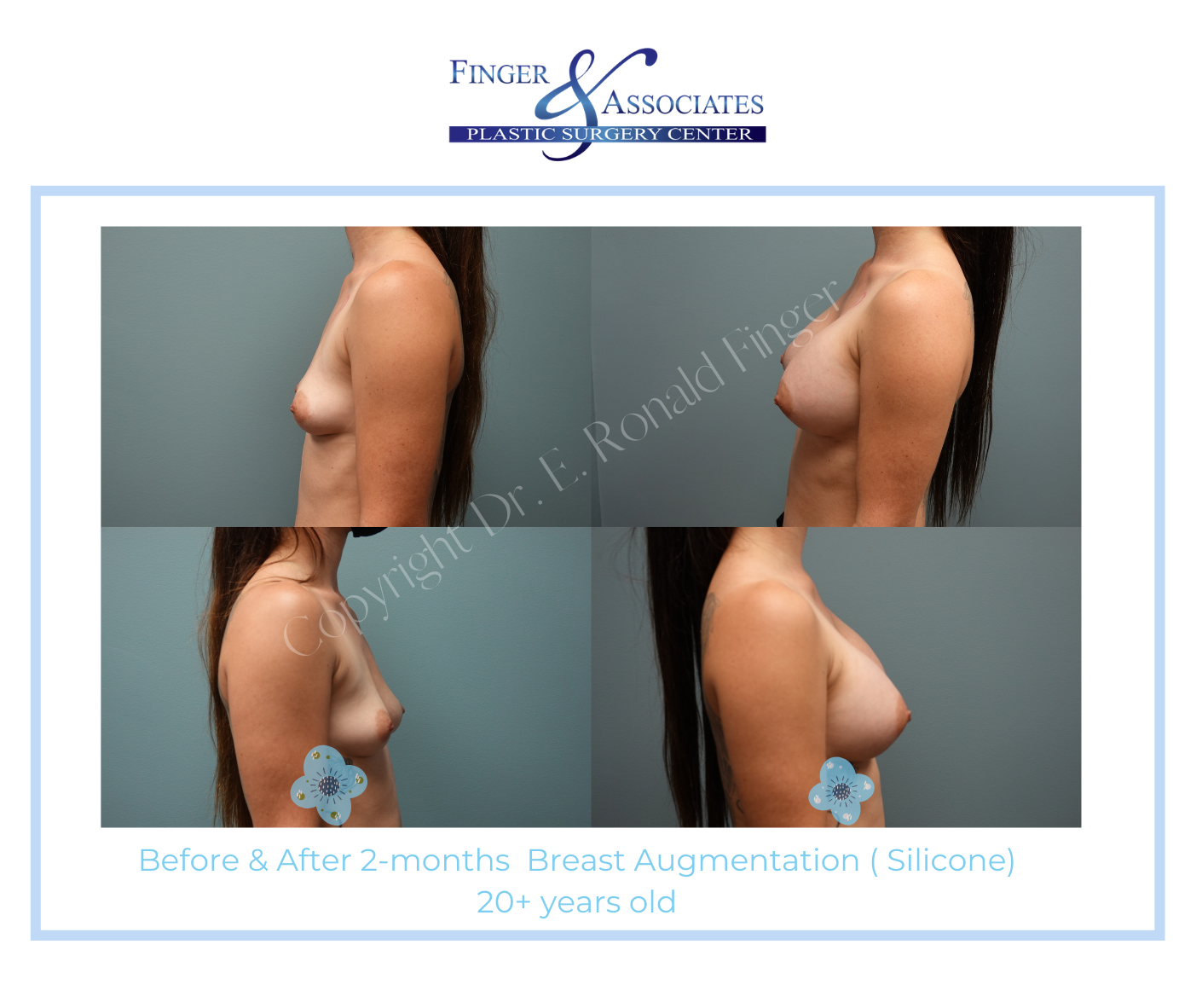 Before and after Breast augmentation