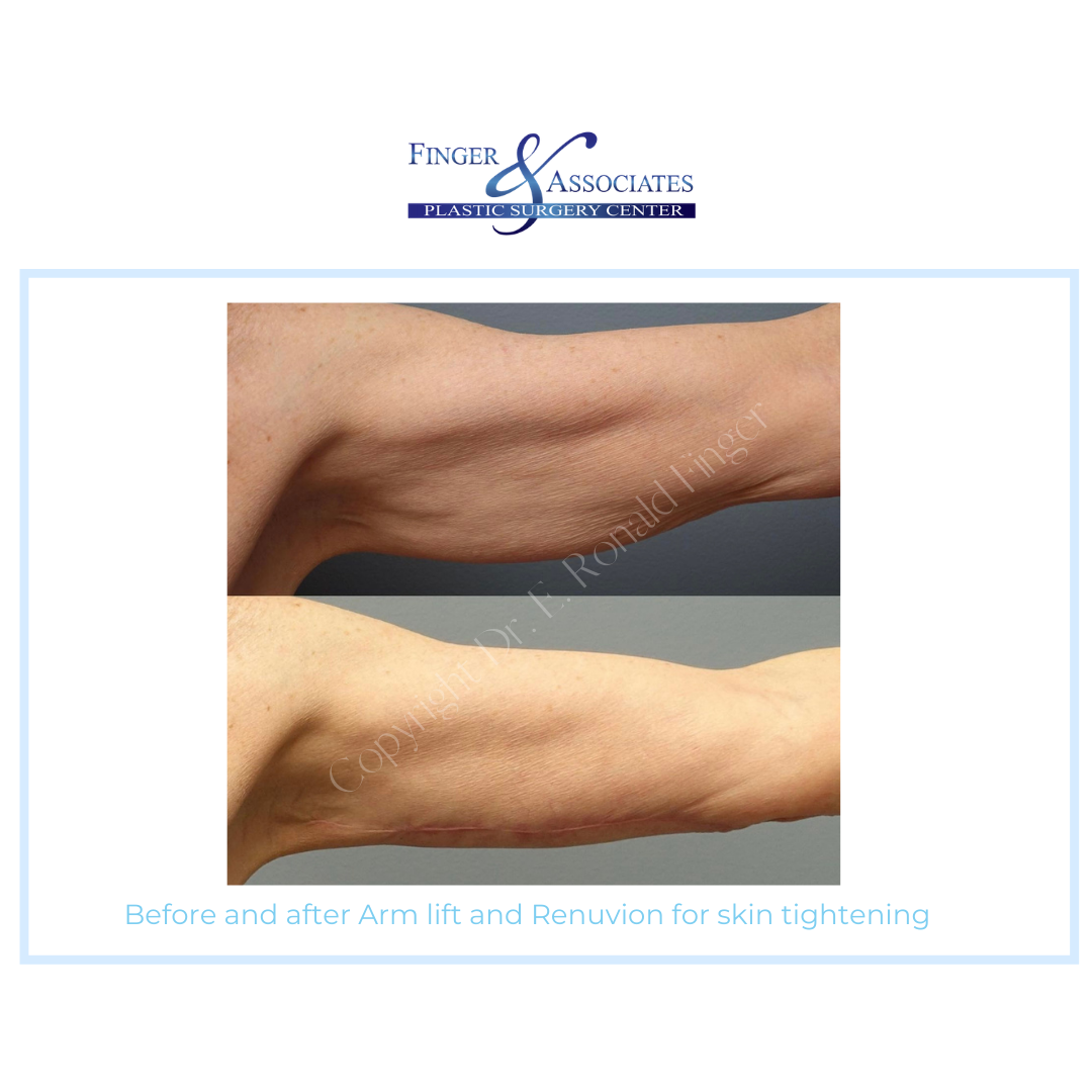 Before and After Arm Lift and Renuvion for Skin Tightening