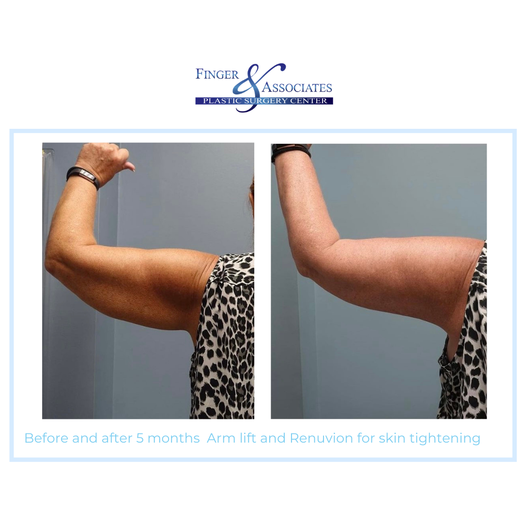 Before and After 5 months Arm Lift and Renuvion for Skin Tightening