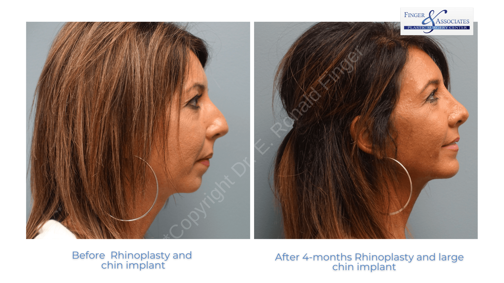 Rhinoplasty before and after