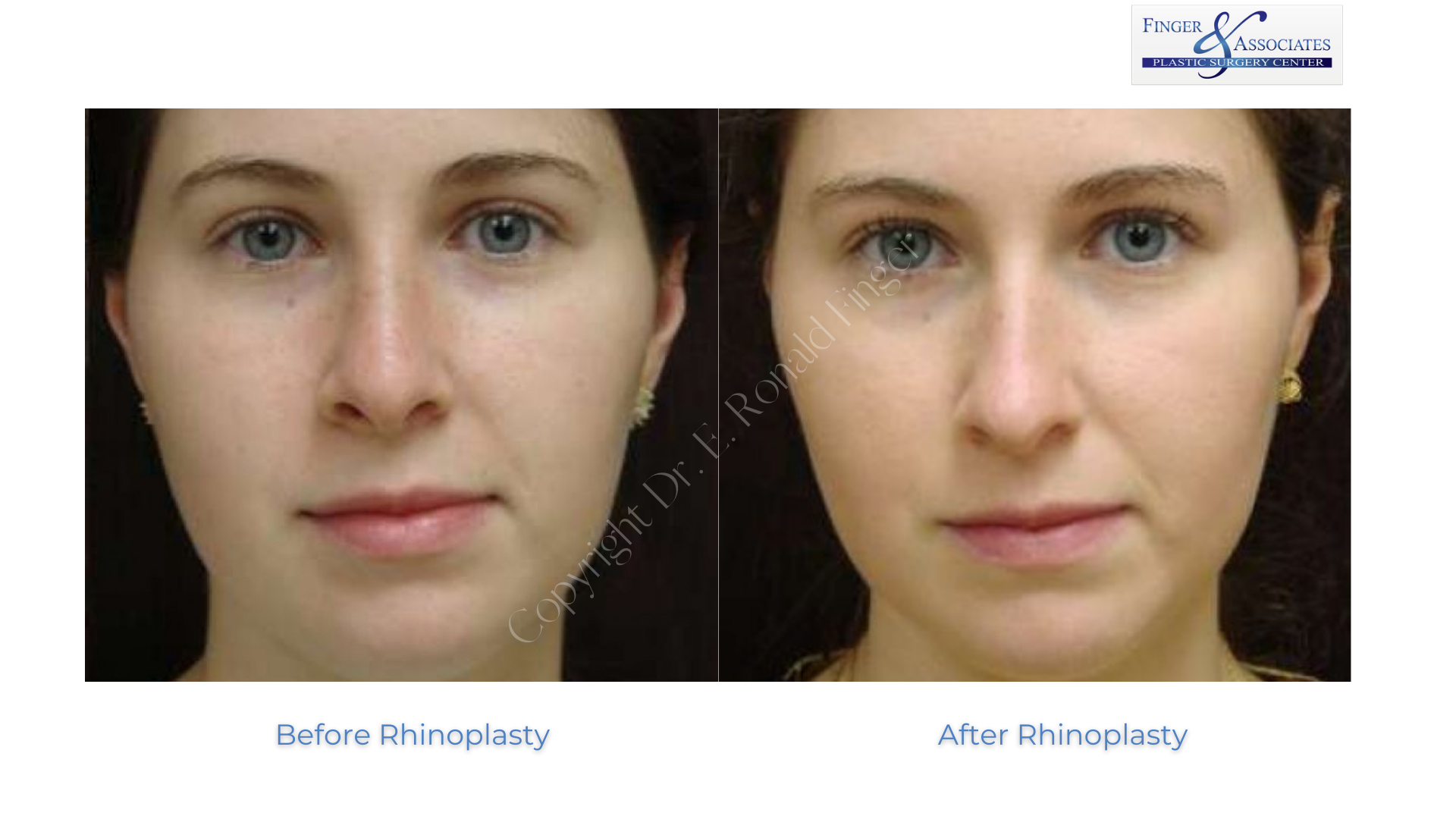 Before and after Rhinoplasty by Dr. Finger