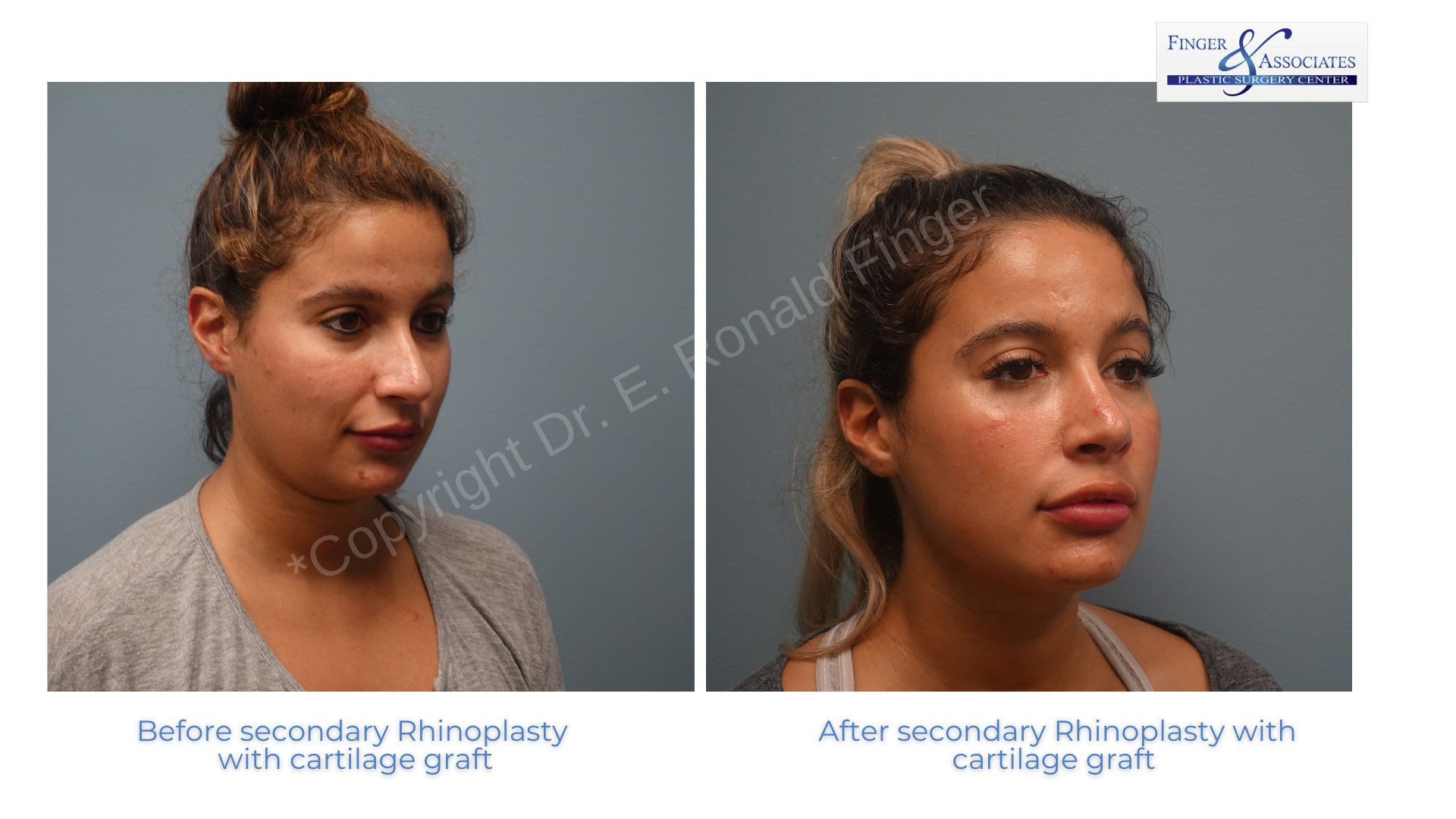rhinplasty before and after