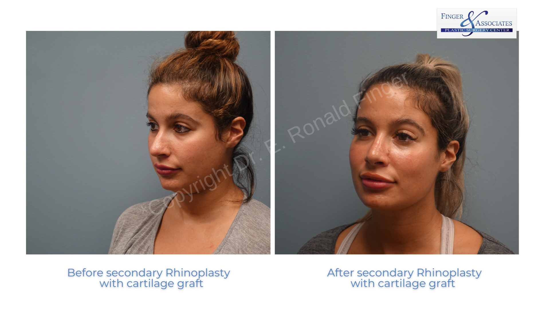 Rhinoplasty before and after