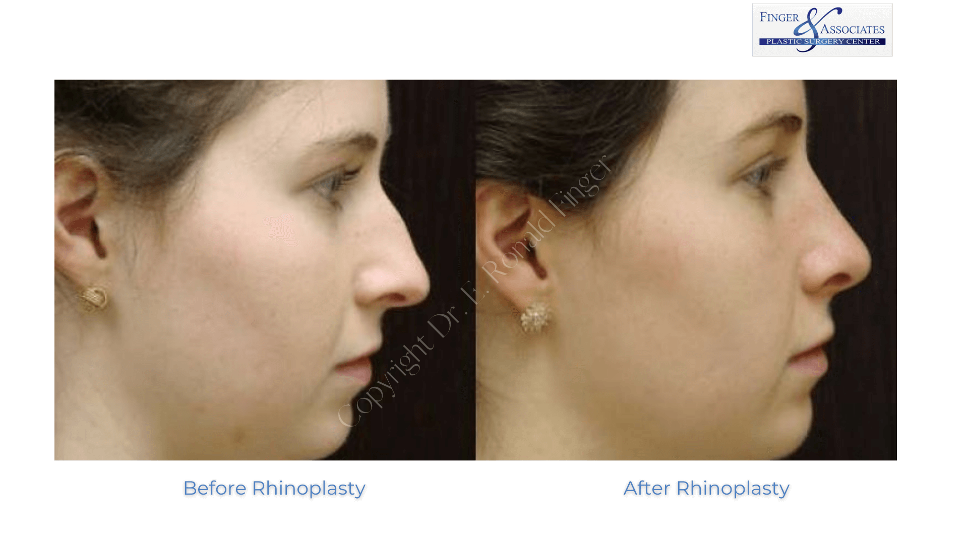 Before and after Rhinoplasty