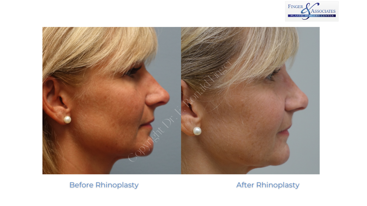 Rhinoplasty before and after