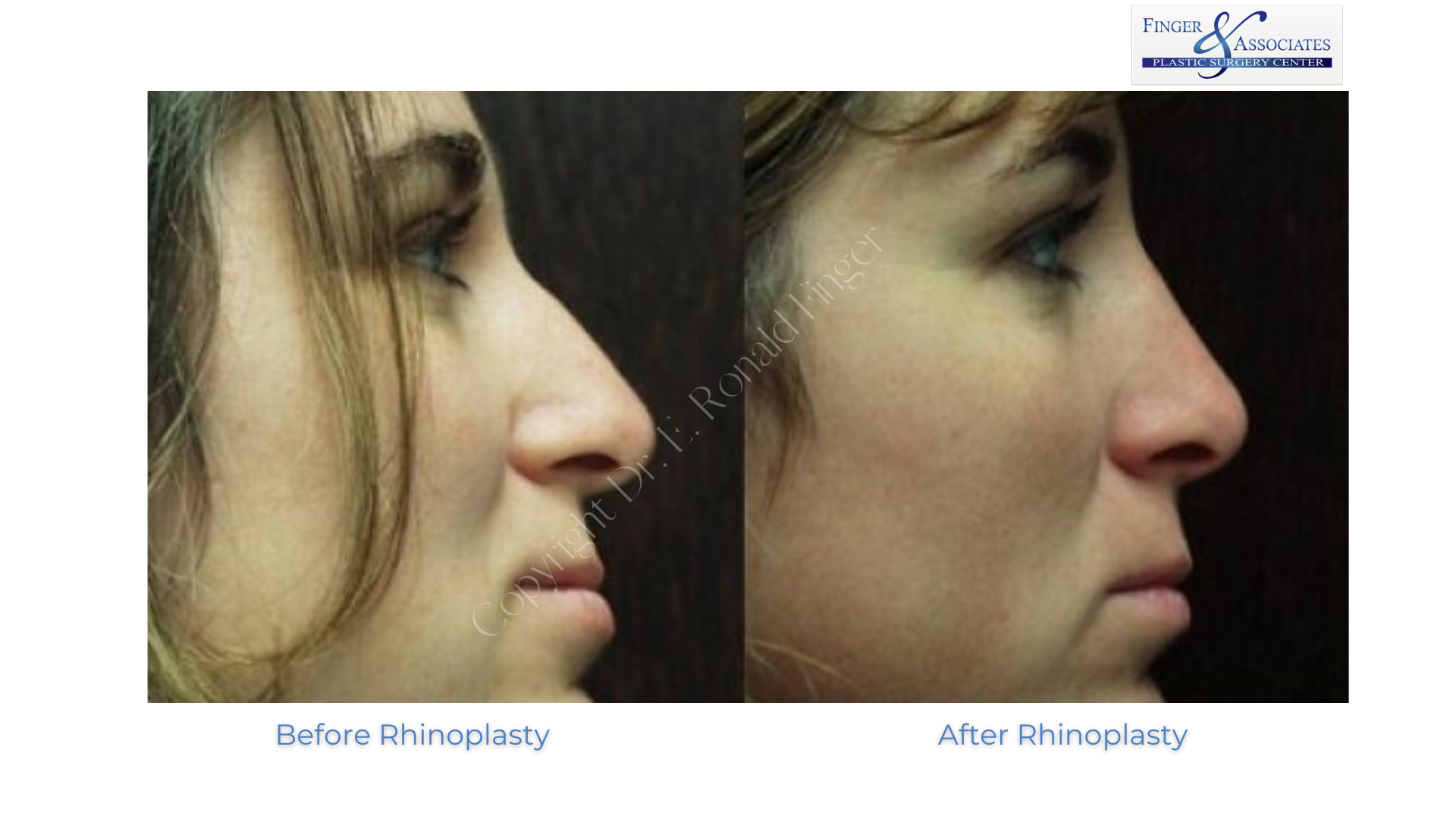Rhinoplasty by Dr. Finger before and after