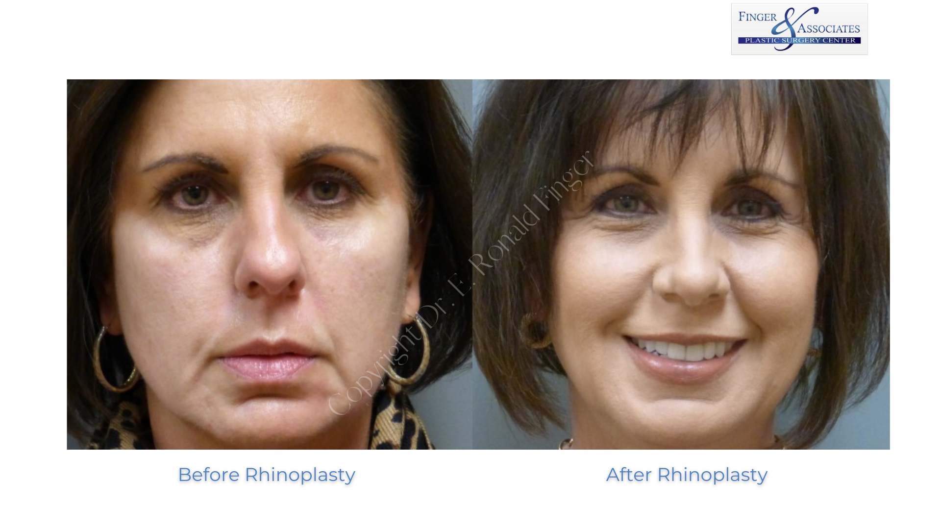 rhinoplasty before and after