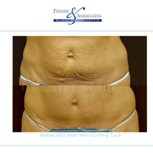 Before and After Mini Tummy Tuck Before and After Mini Tummy Tuck