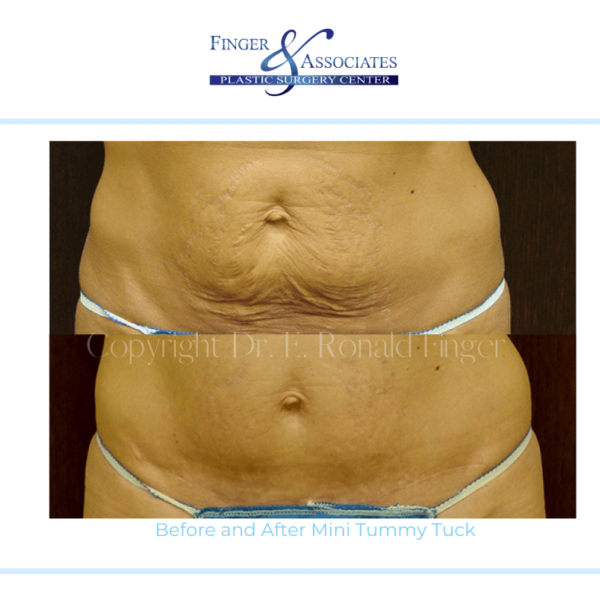 Before and After Mini Tummy Tuck