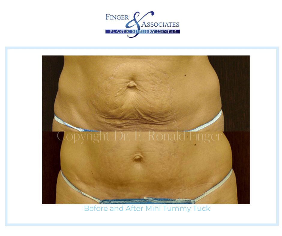 Before and After Mini Tummy Tuck