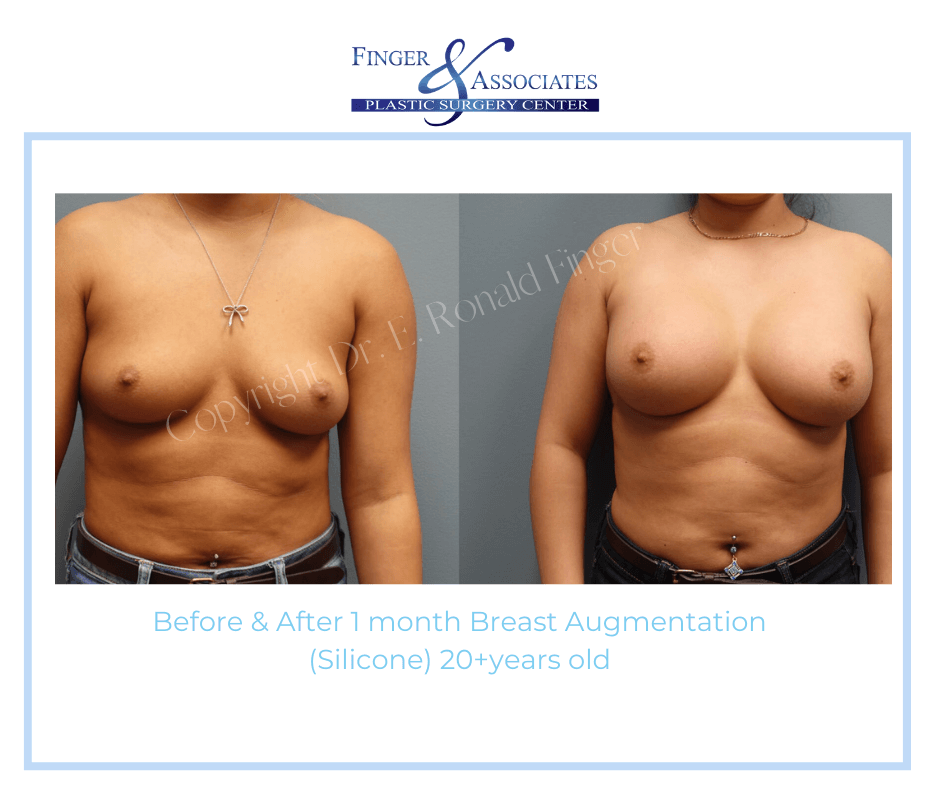 before and after breast augmentation