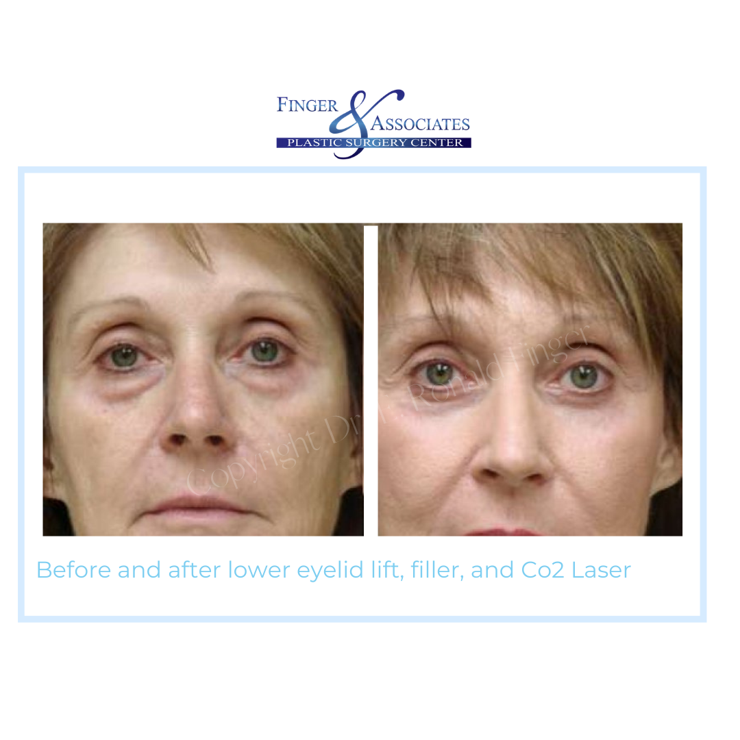 before and after eyelid lift surgery