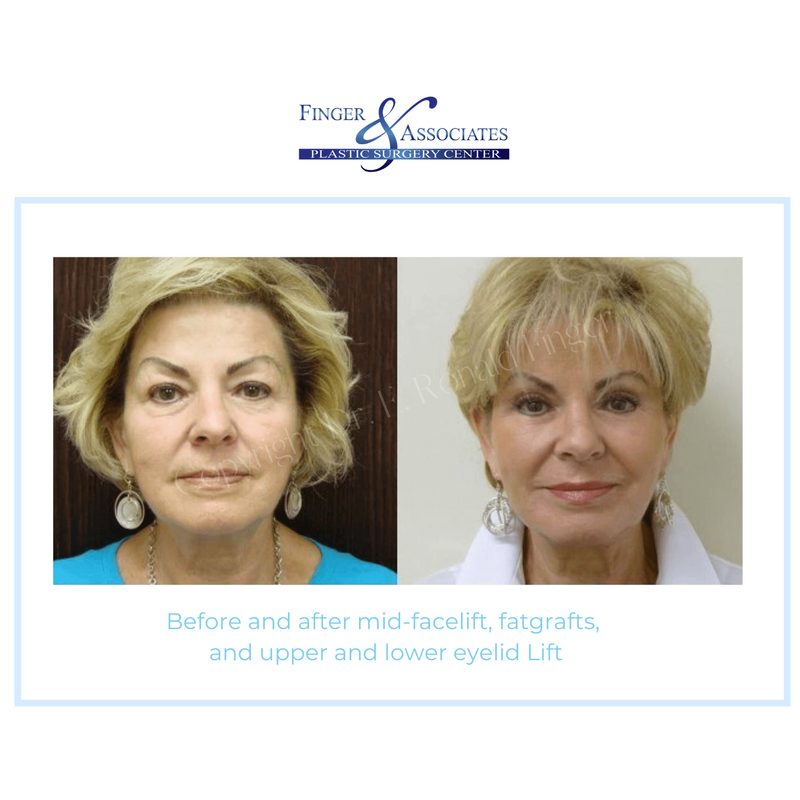 before and after mid facelift and eyelid lift