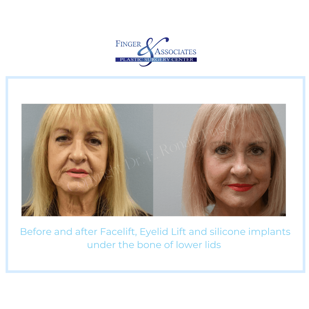 Before and After Facelift, Eyelid Lift and silicone implants under the bone of lower lids