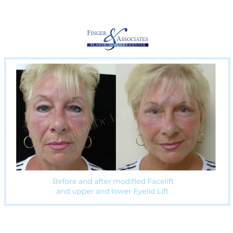 Before and After Modified Facelift and upper and lower Eyelid Lift