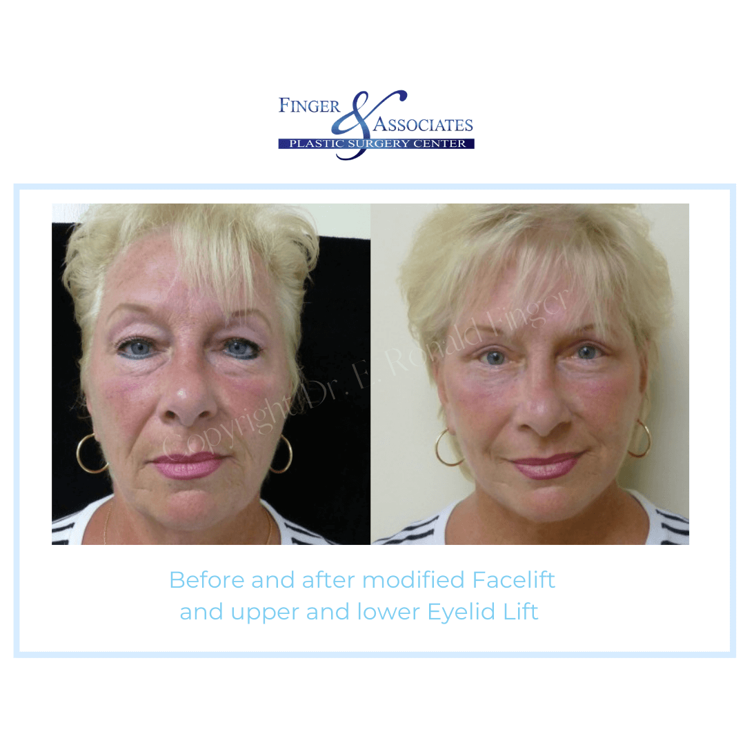 Before and After Modified Facelift and upper and lower Eyelid Lift