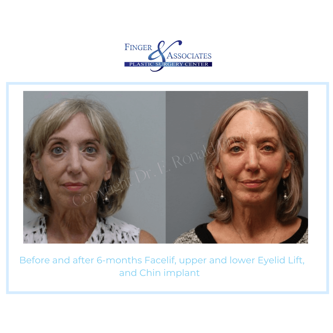 Before and After 6-months Facelift, Upper and Lower Eyelid Lift, and Chin implant